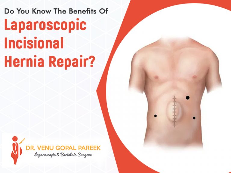 Do You Know The Benefits Of Laparoscopic Incisional Hernia Repair 0733