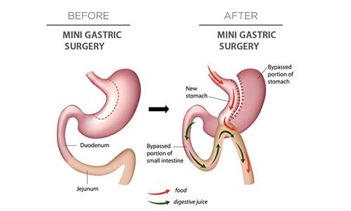 Mini Gastric Bypass - Your Gateway To Diabetes cure?