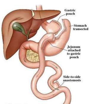 Laparoscopic roux-en-y gastric bypass surgery in Hyderabad
