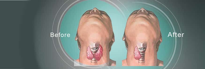 Get Parathyroid Surgery and Treatment By Dr V Pareek, Best Parathyroid Surgeon in Hyderabad