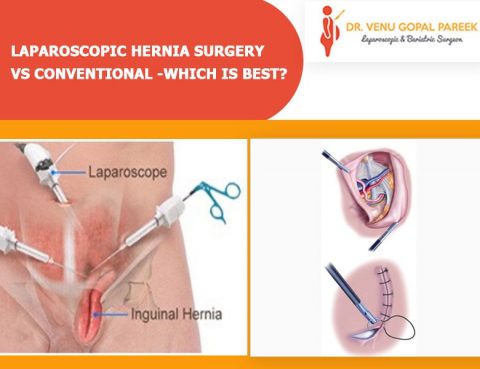 Best Laparoscopic Hernia surgery by Dr. V Pareek, One of the best Bariatric and Laparoscopic surgery specialist in Hyderabad