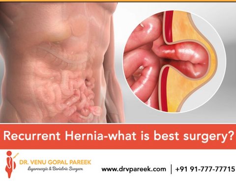 Best Laparoscopic Hernia surgery by Dr. V Pareek, One of the best Bariatric and Laparoscopic surgery specialist in Hyderabad