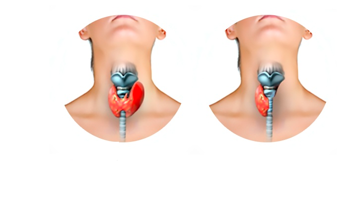 Get now Best thyroid treatment by Dr Venugopal Pareek, One of the best Thyroid Specialist Hyderabad